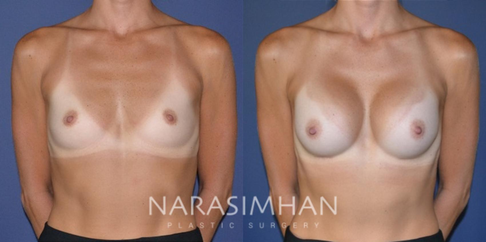Before & After Breast Augmentation Case 187 View #1 View in Tampa, Florida