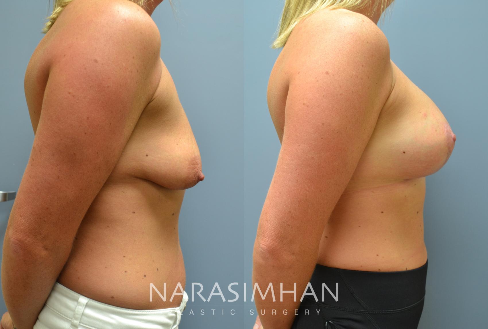Before & After Breast Augmentation with Lift (Mastopexy) Case 12 View #1 View in Tampa, Florida