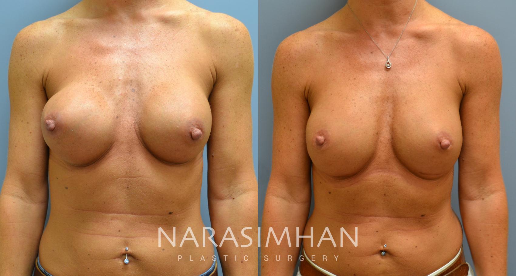 Before & After Breast Implant Revision Case 46 View #1 View in Tampa, Florida