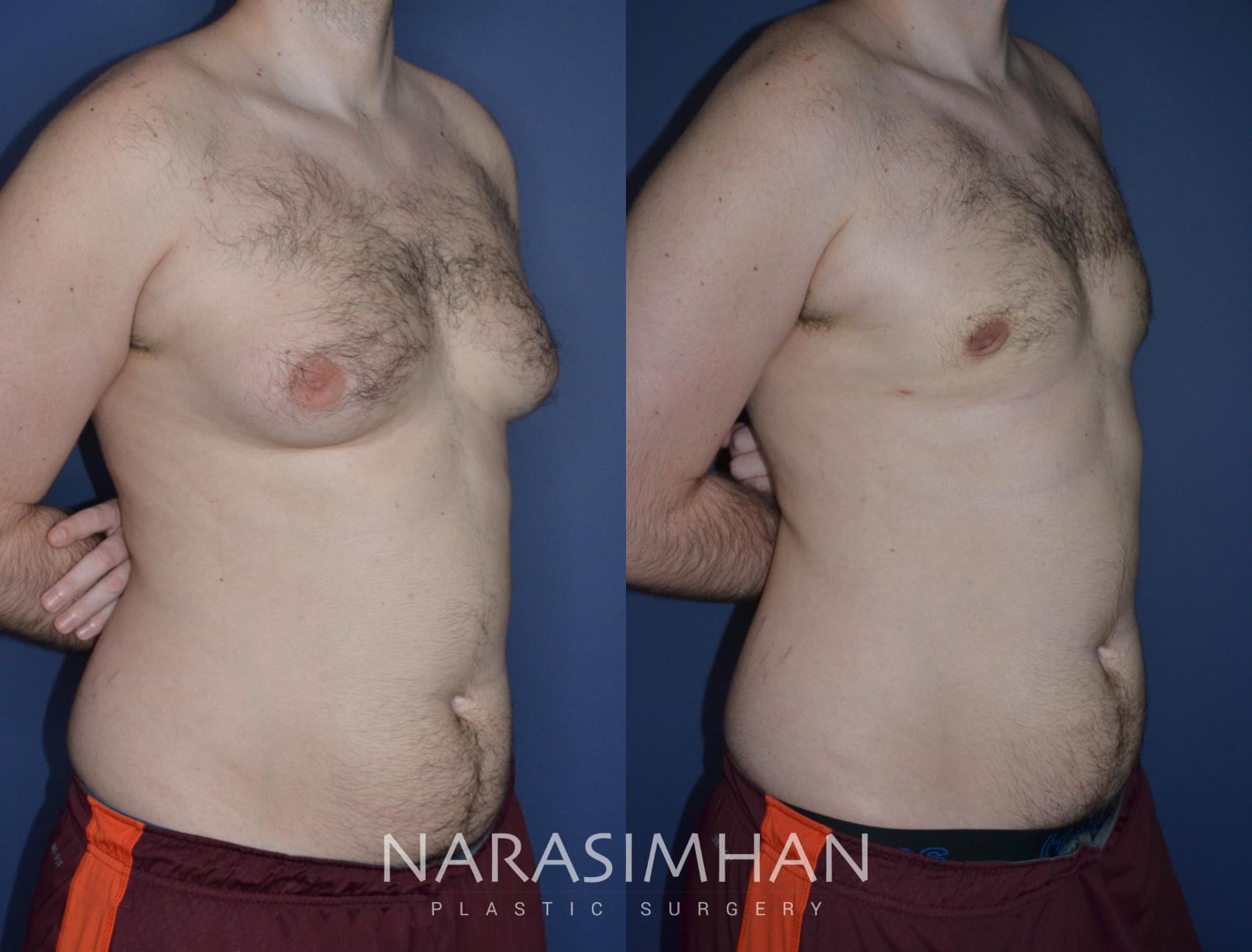 Before & After Male Breast Reduction (Gynecomastia) Case 225 View #1 View in Tampa, Florida