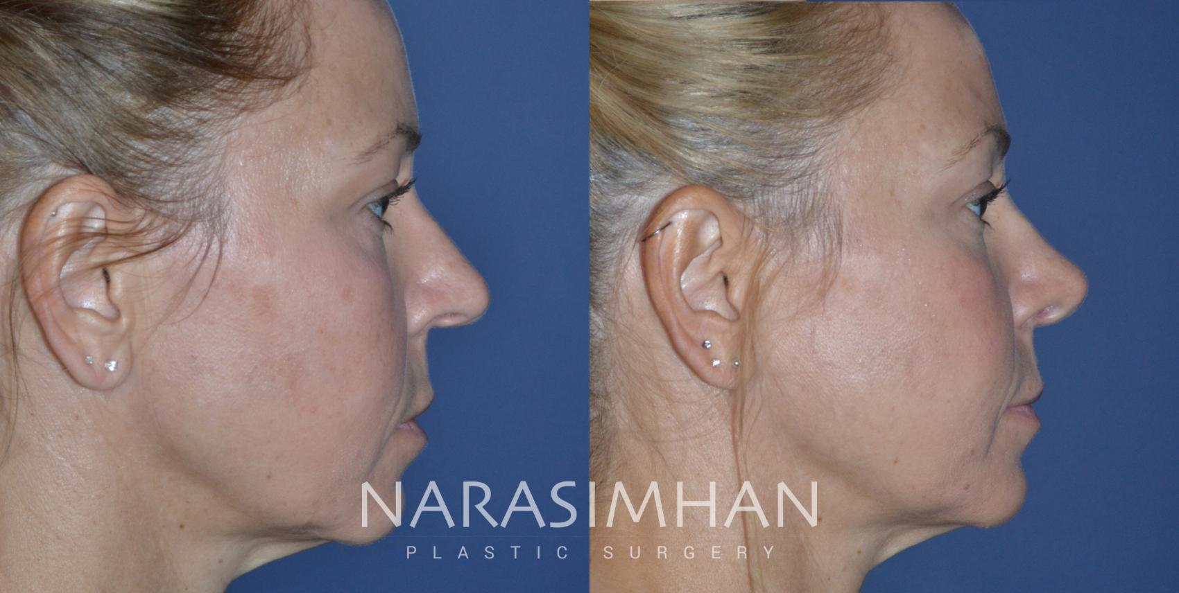 Before & After Rhinoplasty Case 220 View #1 View in Tampa, Florida