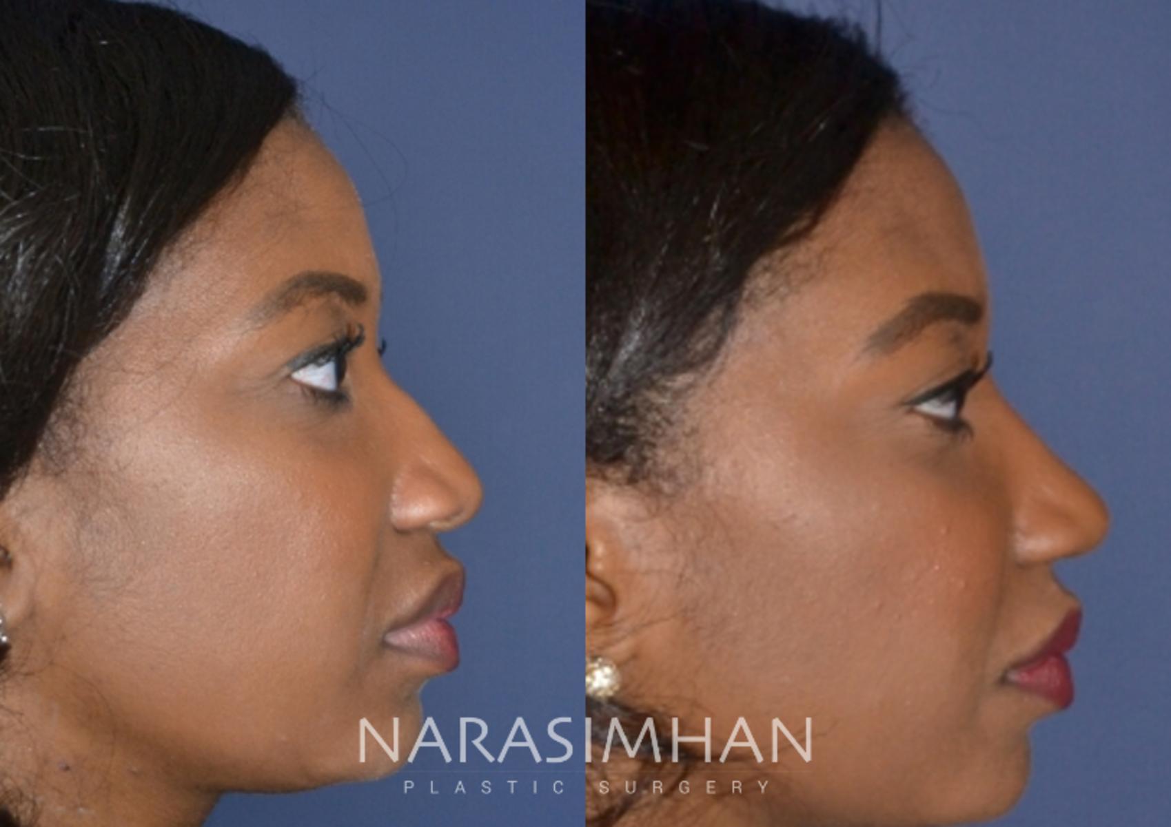 Before & After African American Rhinoplasty Case 159 View #1 View in St Petersburg, Florida