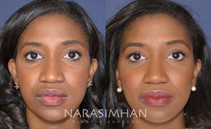 Before & After Rhinoplasty Case 159 View #2 View in Tampa, Florida