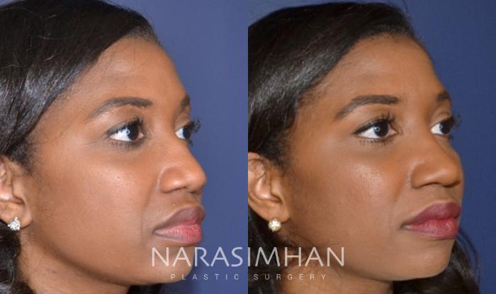 Before & After Ethnic Rhinoplasty Case 159 View #3 View in Tampa, Florida