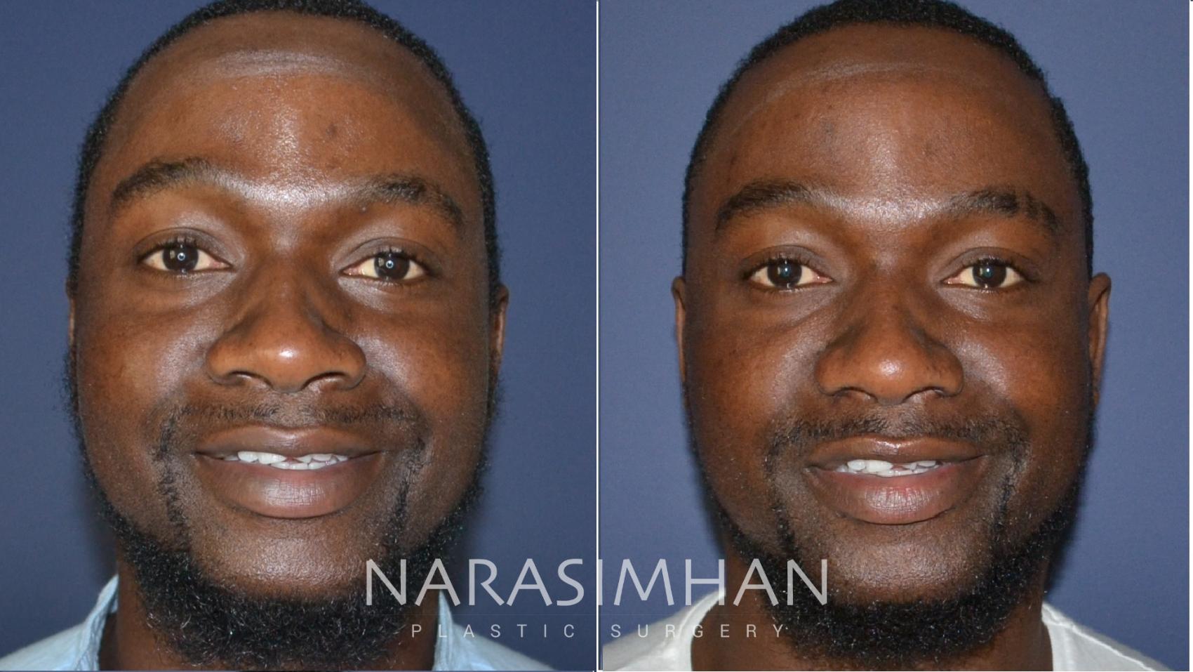 Before & After African American Rhinoplasty Case 183 View #1 View in St Petersburg, Florida