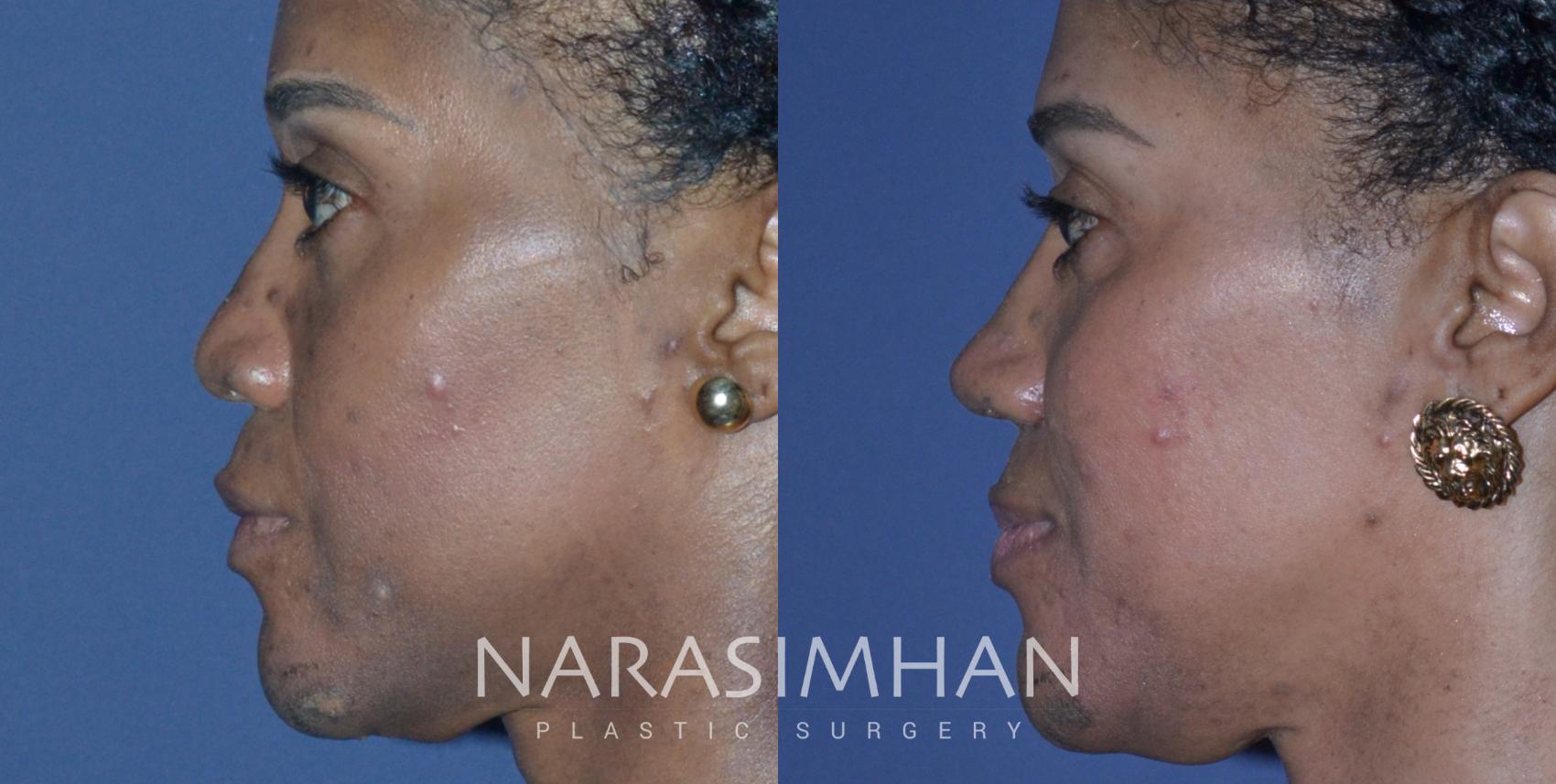 Before & After African American Rhinoplasty Case 227 View #1 View in St Petersburg, Florida