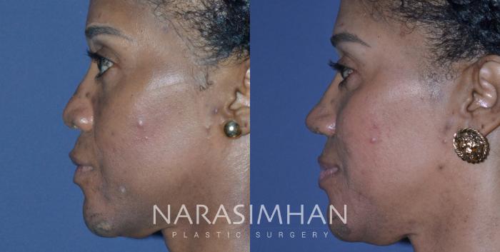 Before & After Ethnic Rhinoplasty Case 227 View #1 View in Tampa, Florida