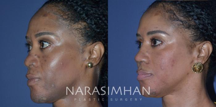 Before & After Ethnic Rhinoplasty Case 227 View #2 View in Tampa, Florida