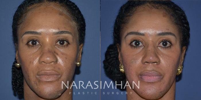 Before & After Ethnic Rhinoplasty Case 227 View #3 View in Tampa, Florida