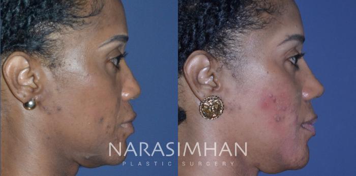 Before & After Ethnic Rhinoplasty Case 227 View #4 View in Tampa, Florida