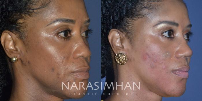 Before & After Ethnic Rhinoplasty Case 227 View #5 View in Tampa, Florida