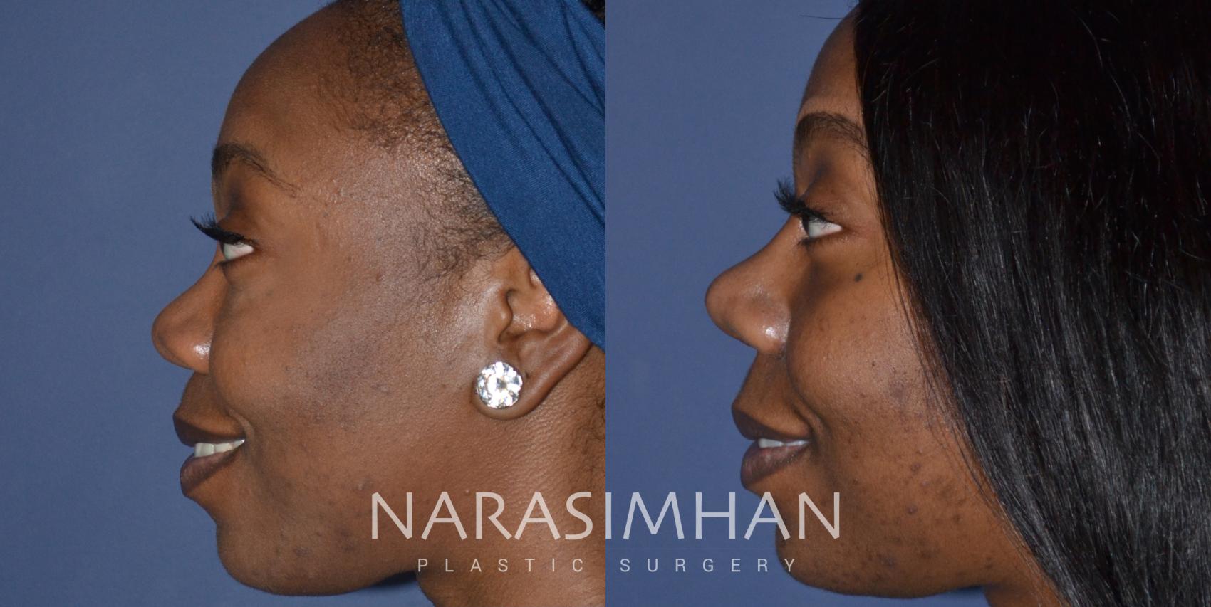 Before & After Ethnic Rhinoplasty Case 247 View #1 View in Tampa, Florida