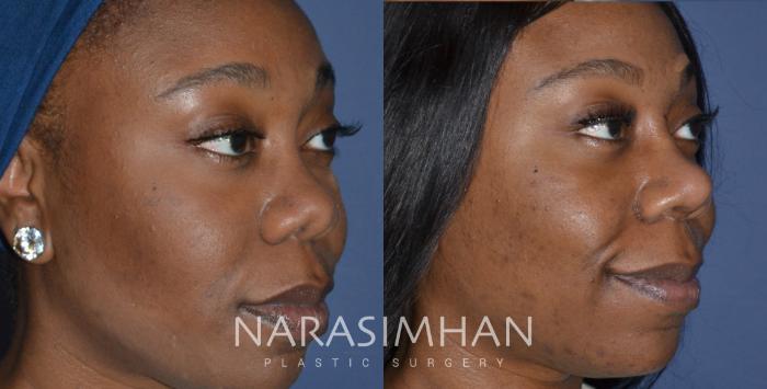 Before & After Ethnic Rhinoplasty Case 247 View #2 View in Tampa, Florida