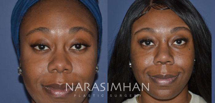 Before & After Rhinoplasty Case 247 View #3 View in Tampa, Florida