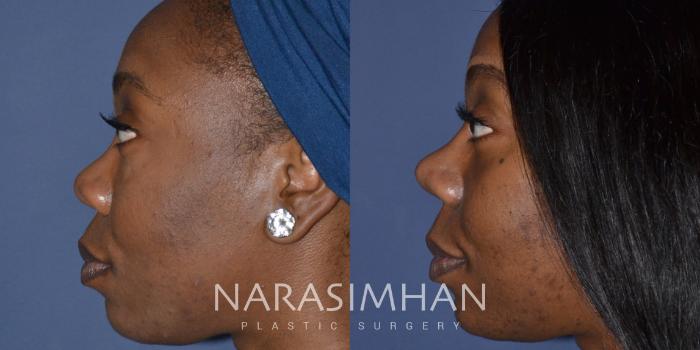 Before & After Ethnic Rhinoplasty Case 247 View #4 View in Tampa, Florida
