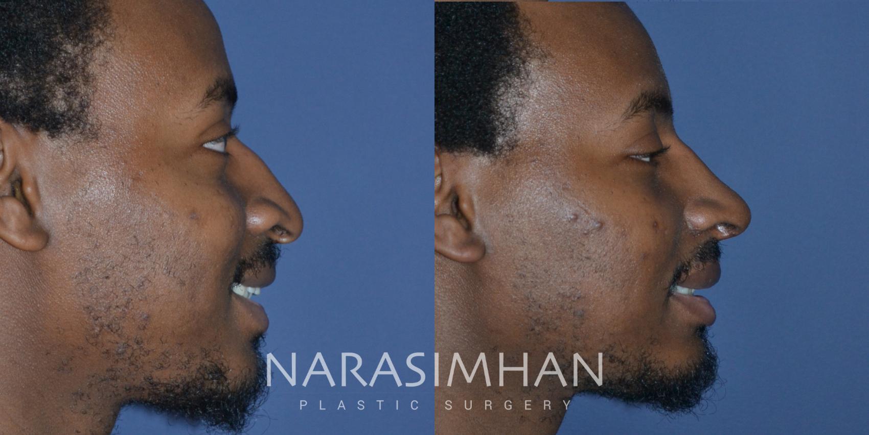 Before & After African American Rhinoplasty Case 268 View #1 View in St Petersburg, Florida