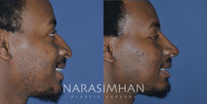 Before & After Rhinoplasty Case 268 View #1 View in Tampa, Florida