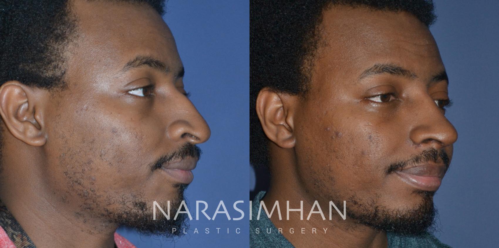 Before & After African American Rhinoplasty Case 268 View #2 View in St Petersburg, Florida