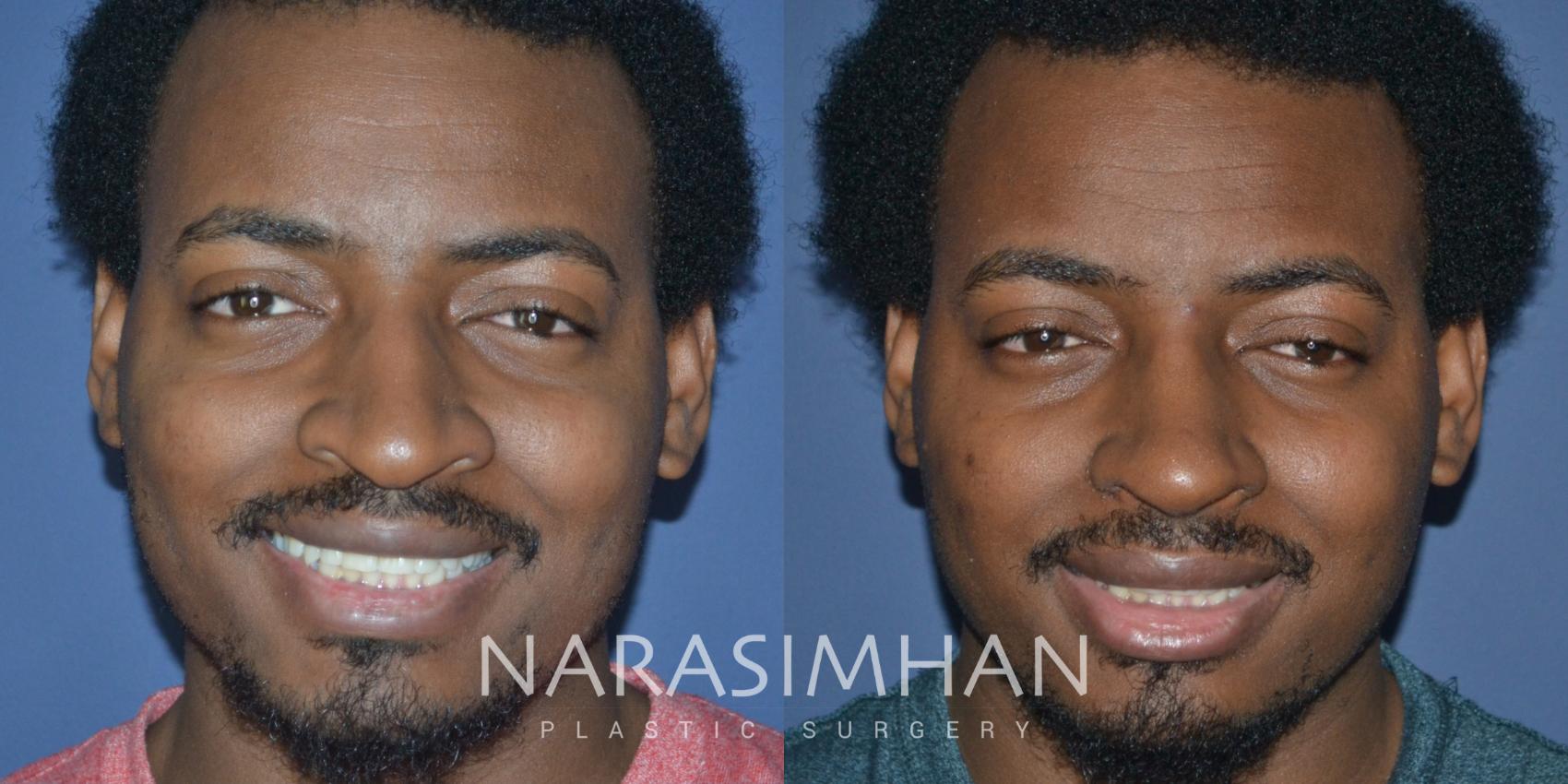 Before & After African American Rhinoplasty Case 268 View #3 View in St Petersburg, Florida