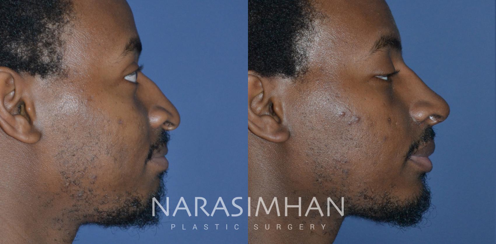 Before & After African American Rhinoplasty Case 268 View #4 View in St Petersburg, Florida