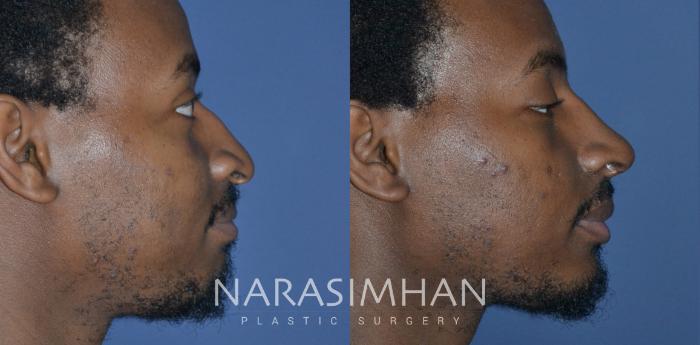 Before & After Ethnic Rhinoplasty Case 268 View #4 View in Tampa, Florida