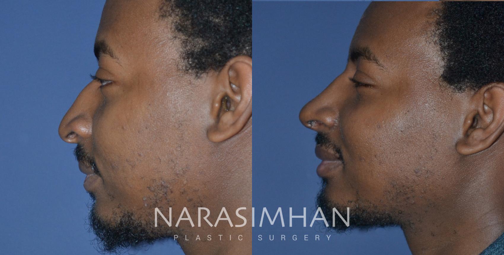 Before & After African American Rhinoplasty Case 268 View #5 View in St Petersburg, Florida