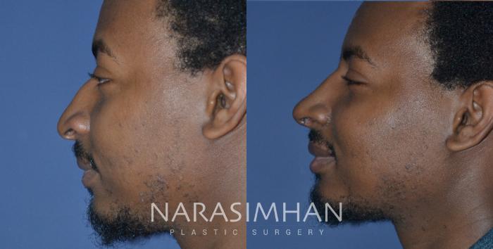 Before & After Rhinoplasty Case 268 View #5 View in Tampa, Florida