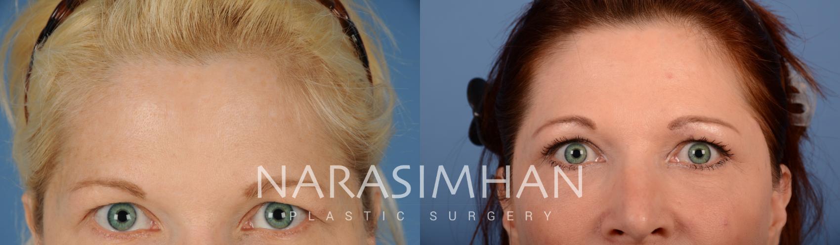Before & After Blepharoplasty Case 103 View #1 View in St Petersburg, Florida