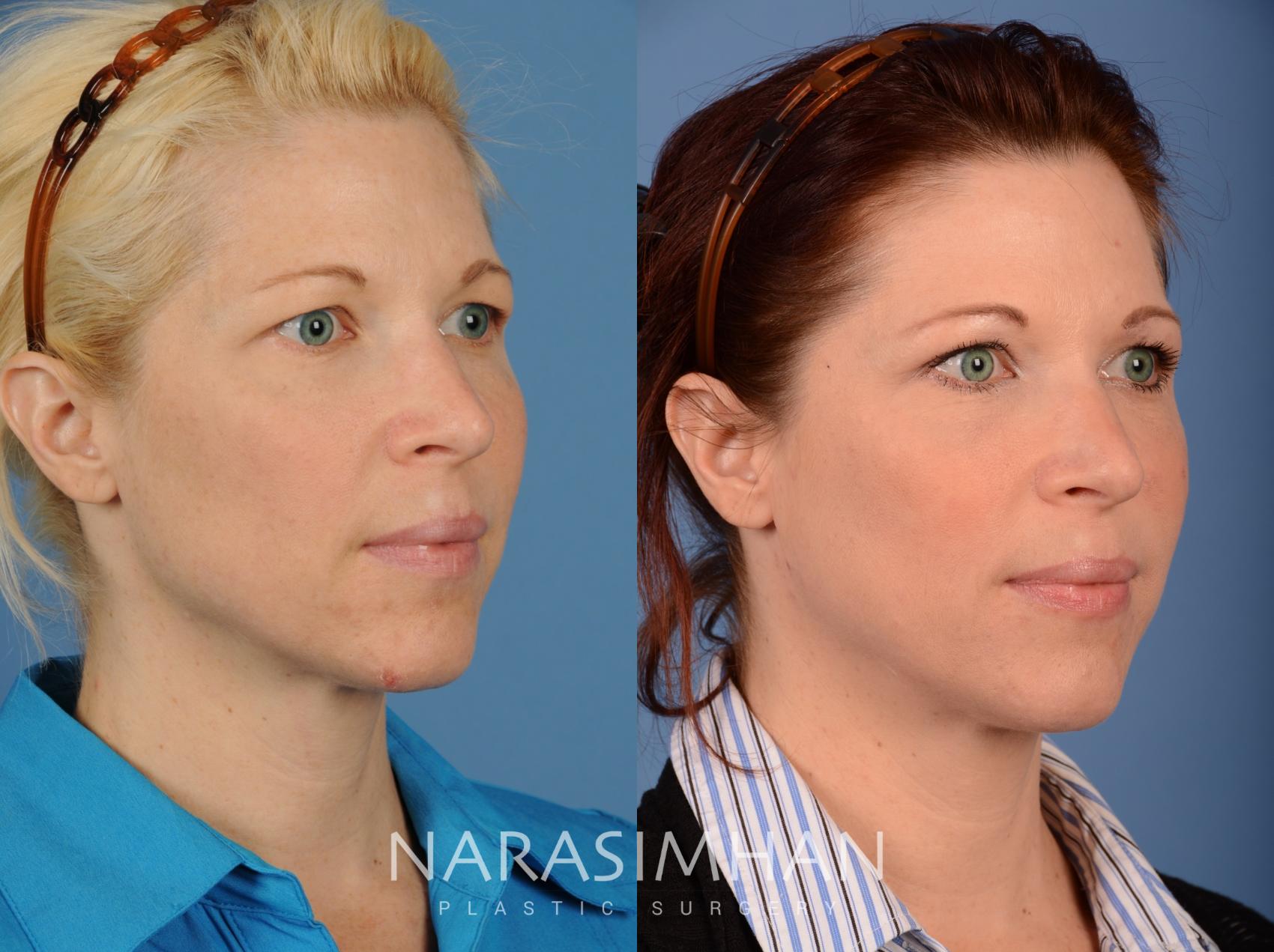 Before & After Blepharoplasty Case 103 View #2 View in St Petersburg, Florida