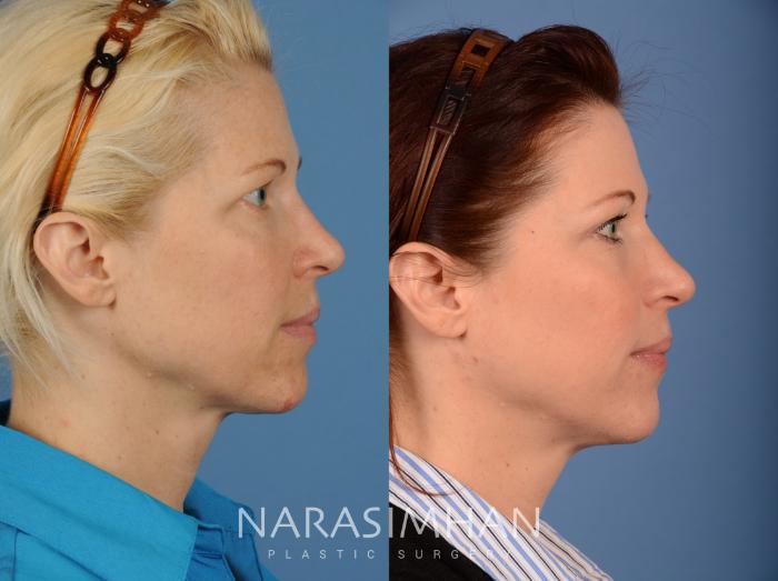 Before & After Blepharoplasty Case 103 View #3 View in Tampa, Florida