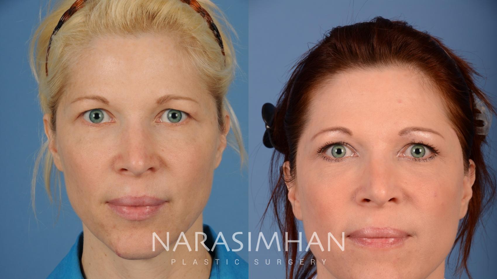 Before & After Blepharoplasty Case 103 View #4 View in St Petersburg, Florida