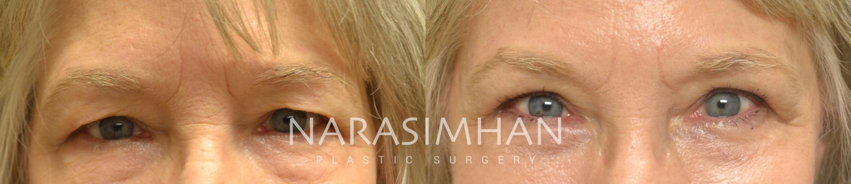 Before & After Blepharoplasty Case 23 View #1 View in St Petersburg, Florida