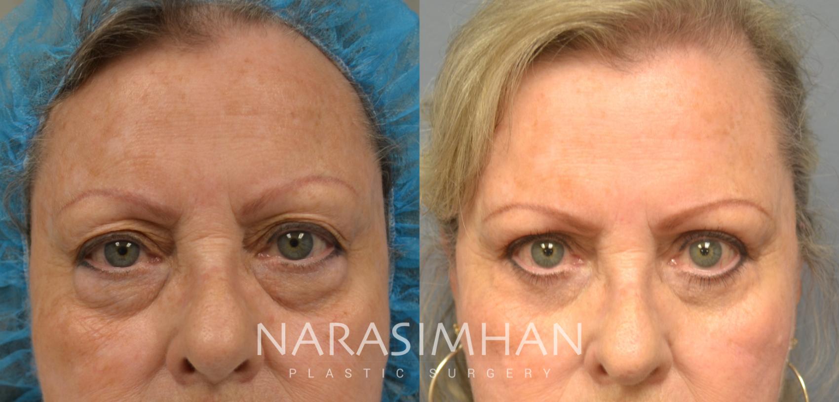 Before & After Blepharoplasty Case 69 View #1 View in St. Petersburg, Florida