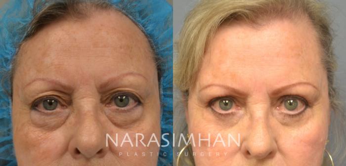 Before & After Blepharoplasty Case 69 View #1 View in Tampa, Florida