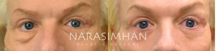 Before & After Blepharoplasty Case 70 View #1 View in Tampa, Florida