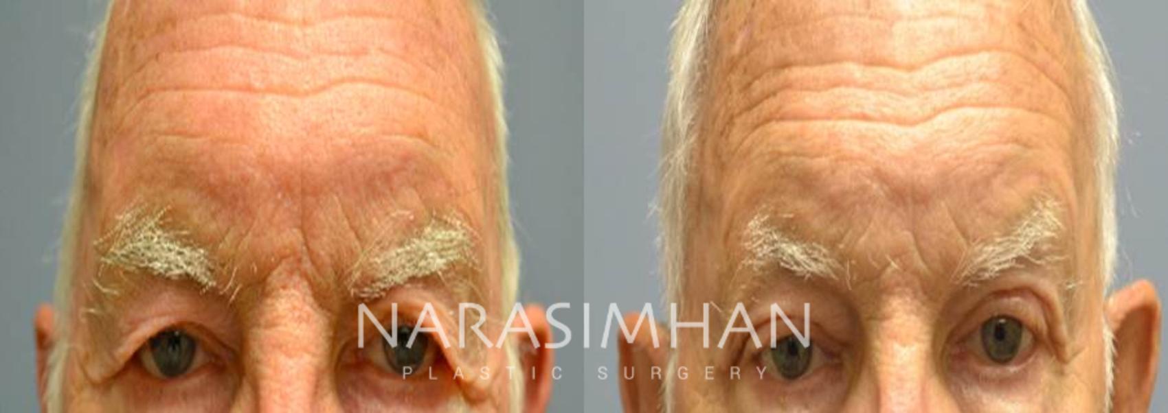 Before & After Blepharoplasty Case 84 View #1 View in St Petersburg, Florida