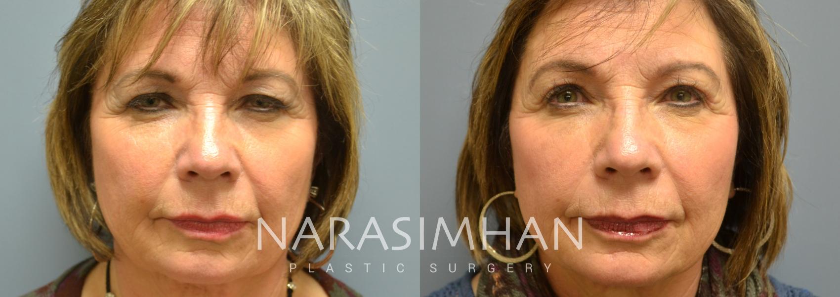 Before & After Blepharoplasty Case 9 View #1 View in Tampa, Florida