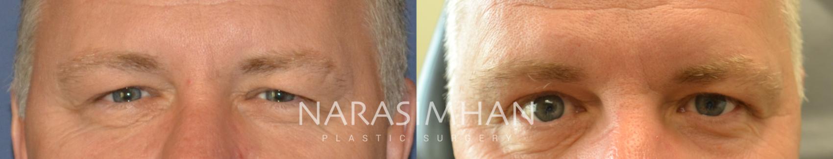 Before & After Blepharoplasty Case 99 View #1 View in St Petersburg, Florida