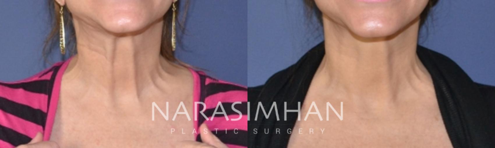 Before & After Botox  Case 137 View #1 View in St Petersburg, Florida