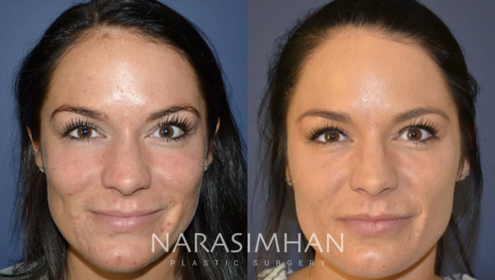 Before & After Botox  Case 141 View #1 View in St Petersburg, Florida