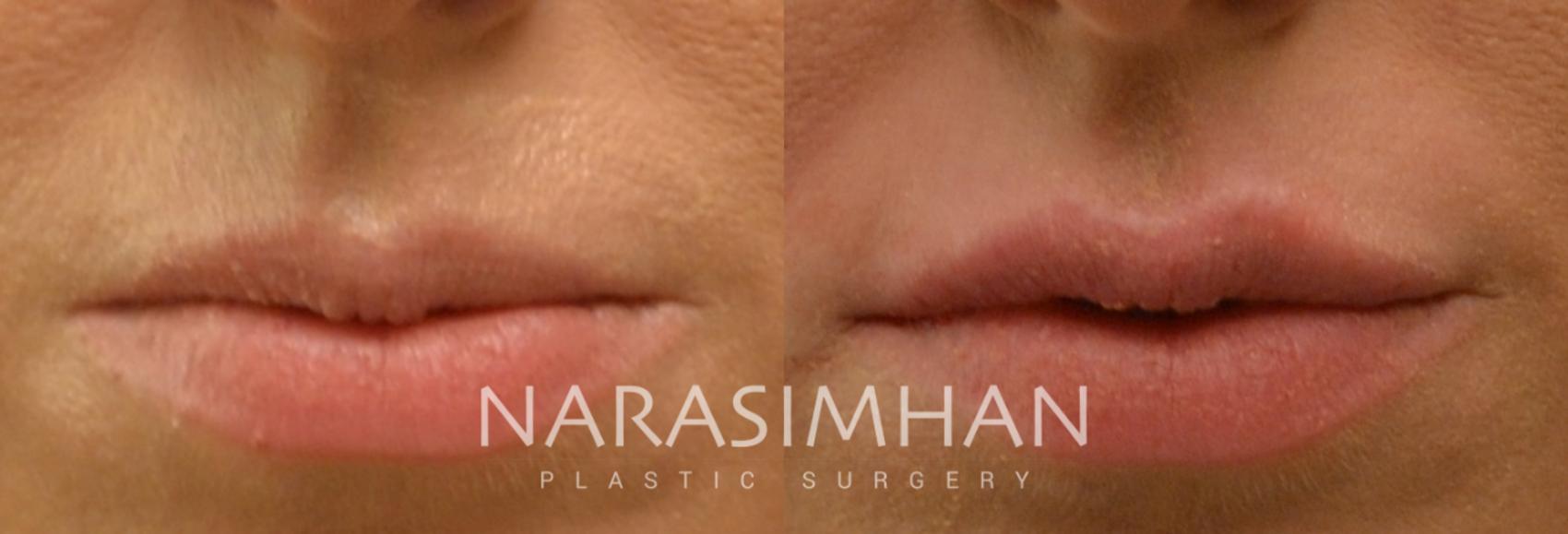 Before & After Lip Augmentation Case 62 View #1 View in St Petersburg, Florida