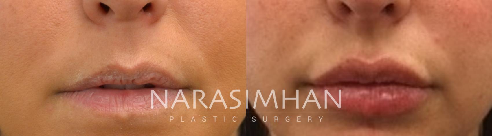 Before & After Lip Augmentation Case 66 View #1 View in St Petersburg, Florida