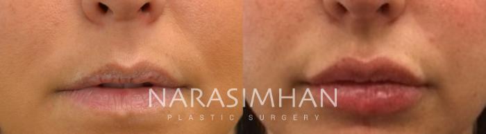 Before & After Lip Augmentation Case 66 View #1 View in Tampa, Florida