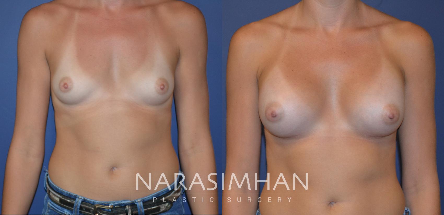 Before & After Breast Augmentation Case 112 View #1 View in Tampa, Florida