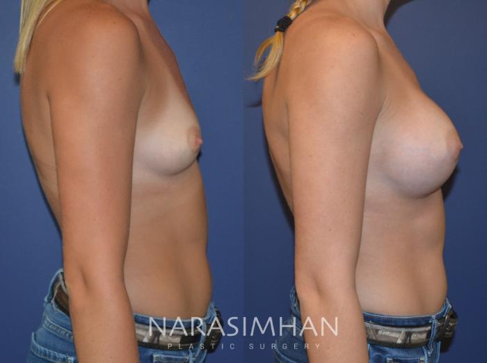 Before & After Breast Augmentation Case 112 View #3 View in Tampa, Florida