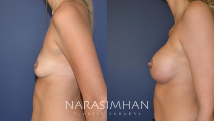 Before & After Breast Augmentation Case 142 View #2 View in St Petersburg, Florida