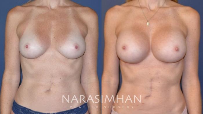 Before & After Breast Augmentation Case 145 View #1 View in Tampa, Florida