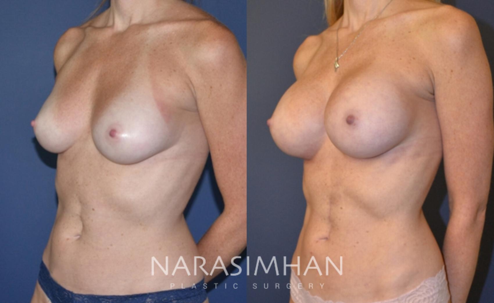 Before & After Breast Augmentation Case 145 View #2 View in St Petersburg, Florida