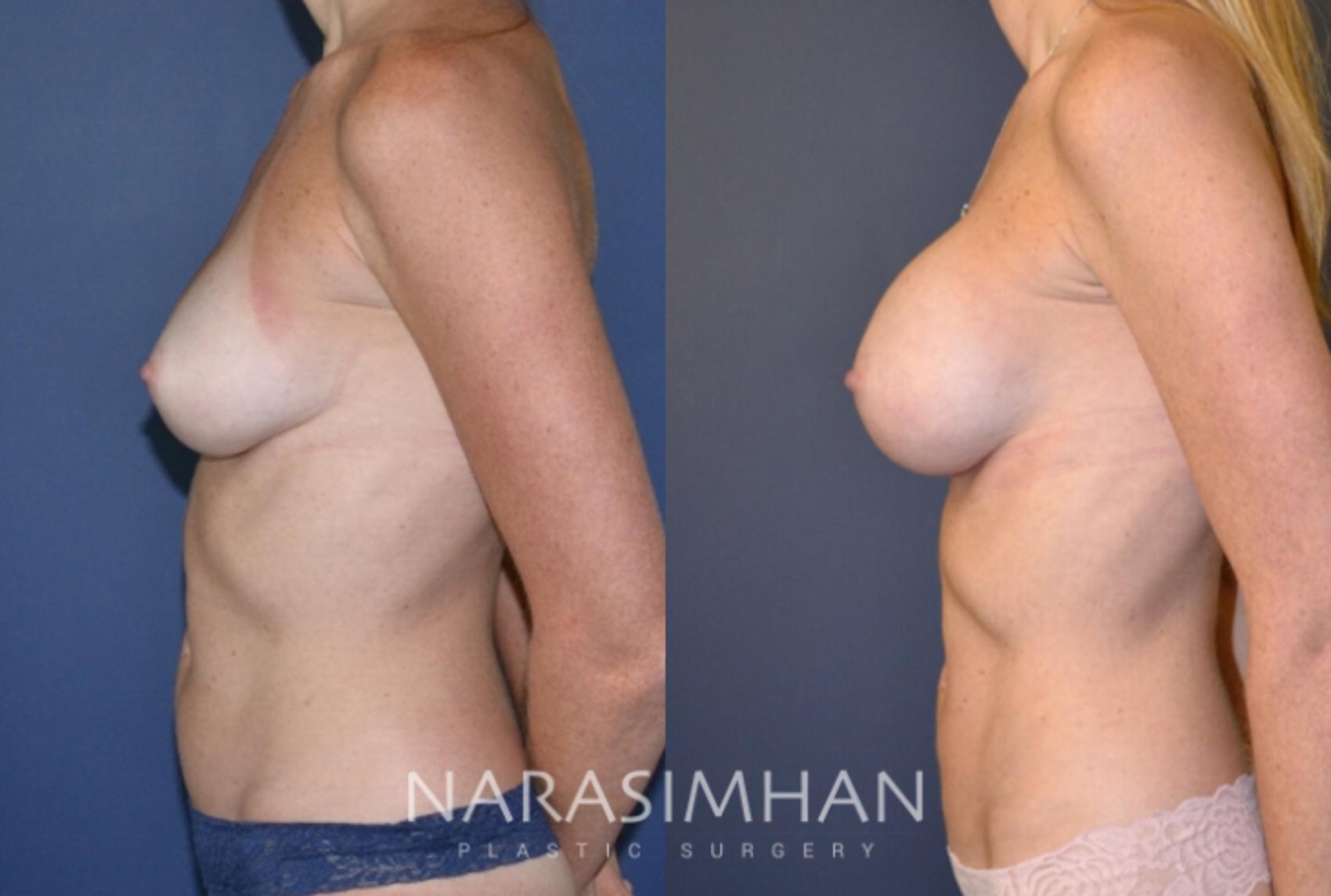 Before & After Breast Augmentation Case 145 View #3 View in St Petersburg, Florida