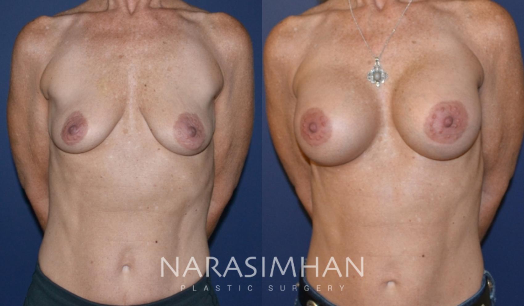 Before & After Breast Augmentation Case 147 View #1 View in St. Petersburg, Florida